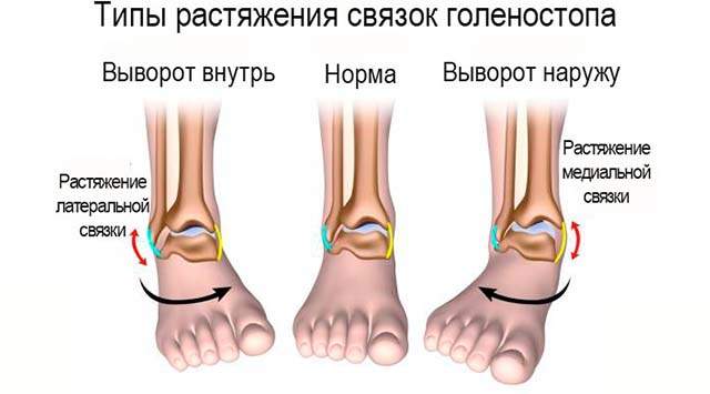 отек голеностопа на одной ноге лечение в домашних условиях