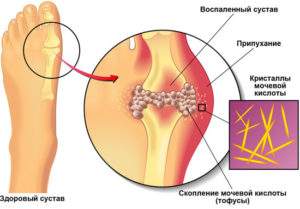 отек голеностопа на одной ноге причины без болевого симптома