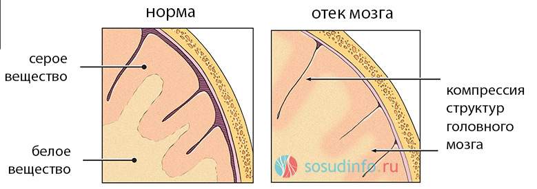 отек головного мозга после операции что это и какие последствия