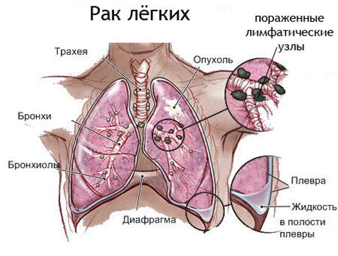 отек легких при раке легких 4 стадии с метастазами