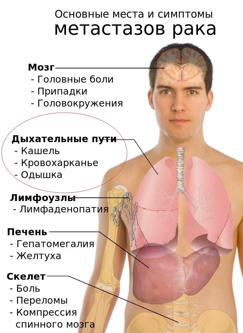 отек легких при раке легких 4 стадии с метастазами