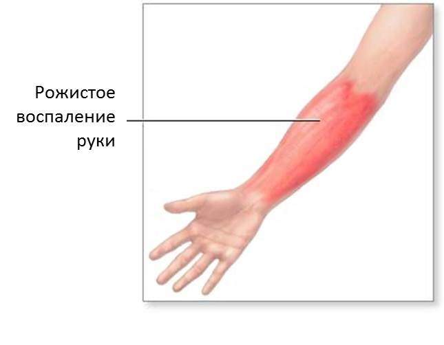 отек мягких тканей наиболее выражен при локализации рожистого процесса на