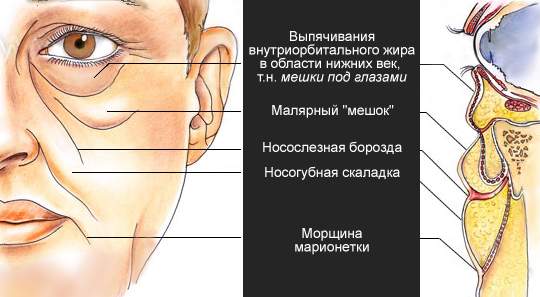 отеки на скулах под глазами как избавиться в домашних условиях