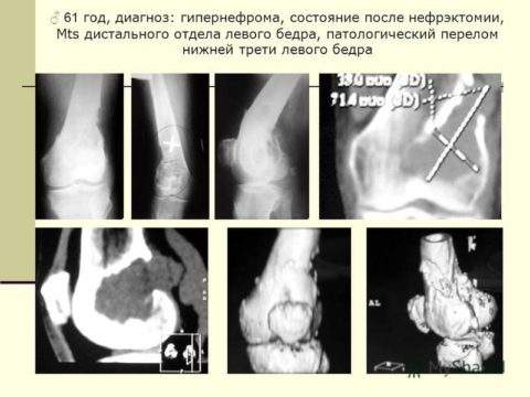 патологический перелом шейки бедра при онкологии лечение