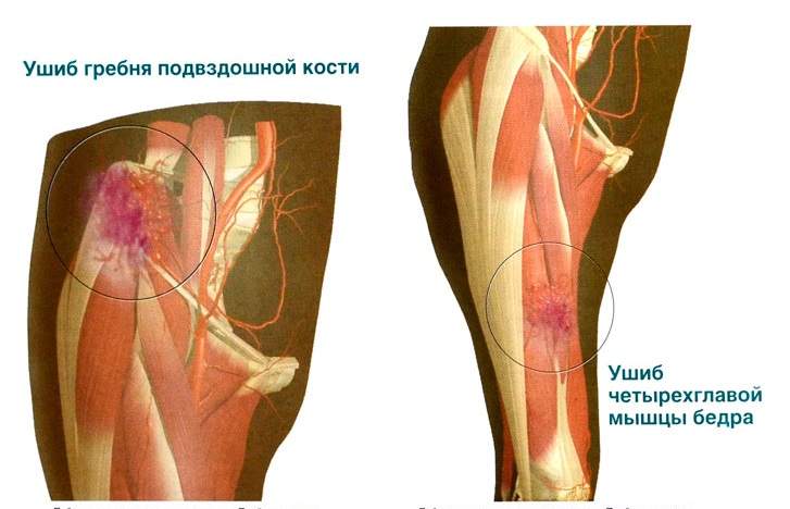 перечислите действия которые необходимо совершить при ушибе бедра