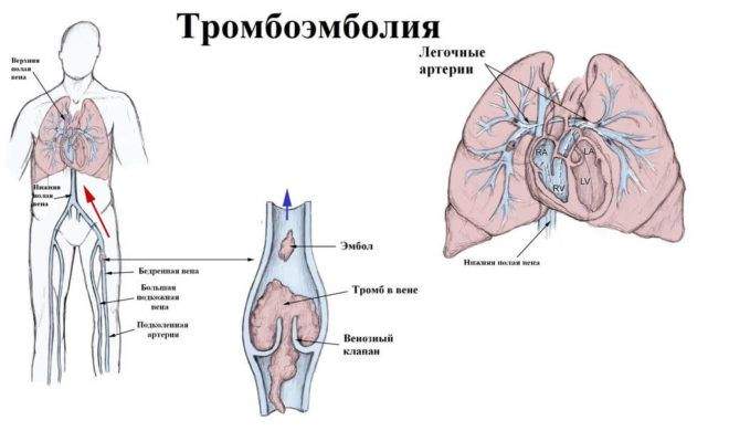 перелом большого вертела бедренной кости у пожилых