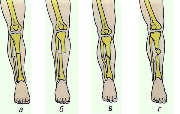 перелом большой берцовой кости косой со смещением