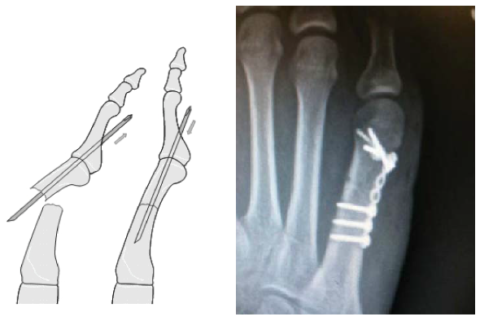 Остеосинтез 5 плюсневой кости. Перелом плюсневой кости 5 кости. Перелом 5 плюсневой кости остеосинтез. Остеосинтез 5 плюсневая кость стопы.