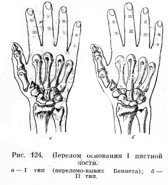 Перелом кисти карта вызова