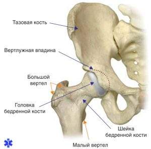 перелом дна вертлужной впадины со смещением отломков