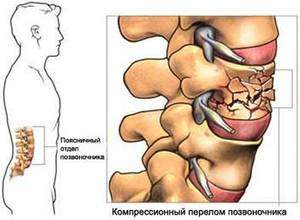 перелом дужки позвонка поясничного отдела лечение последствия