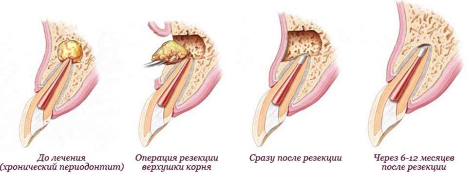 перелом корня зуба под коронкой консервативное лечение