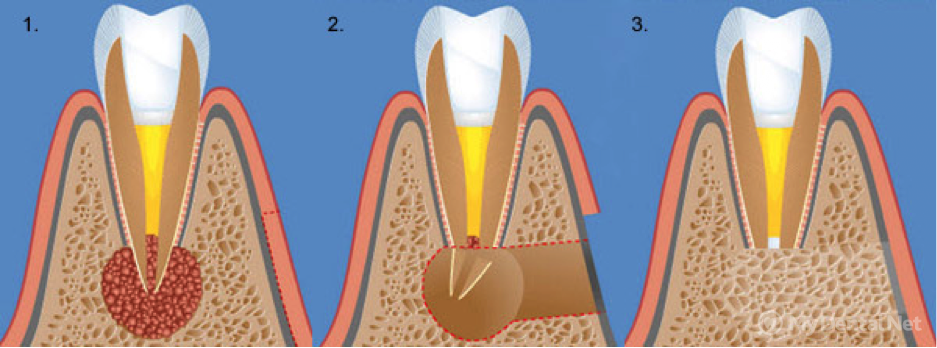 перелом корня зуба под коронкой консервативное лечение