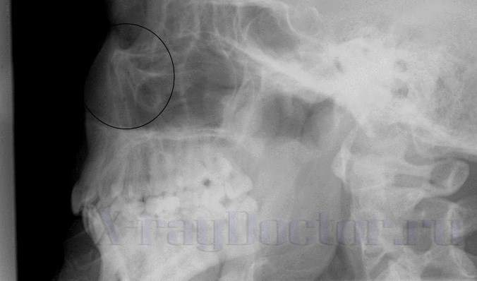 перелом костей носа рентгенограммы в боковой проекции