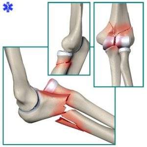перелом локтевого отростка локтевой кости без смещения