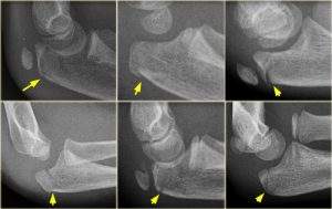 перелом локтевого отростка локтевой кости без смещения
