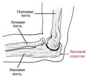 перелом локтевого отростка локтевой кости со смещением