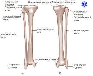 перелом малоберцовой и большеберцовой кости со смещением