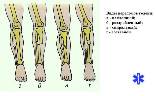 перелом малоберцовой и большеберцовой кости со смещением