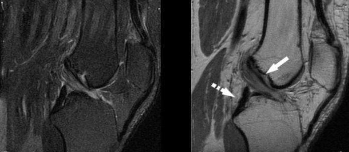 перелом мениска коленного сустава симптомы и лечение