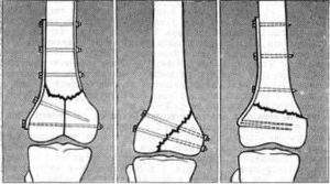 перелом межмыщелкового возвышения большеберцовой кости сроки лечения