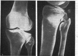 перелом межмыщелкового возвышения большеберцовой кости сроки лечения