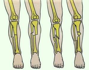 перелом межмыщелкового возвышения большеберцовой кости у детей