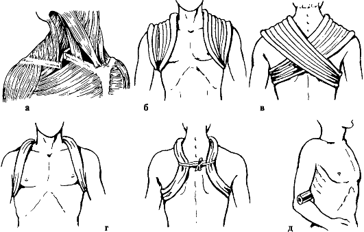 перелом на уровне плечевого пояса и плеча