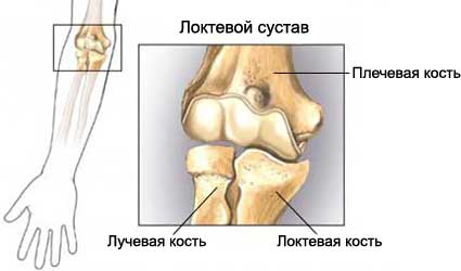 перелом наружного мыщелка плечевой кости у детей