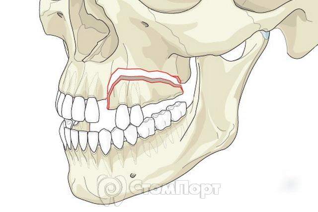 перелом нижней челюсти во время удаления зуба
