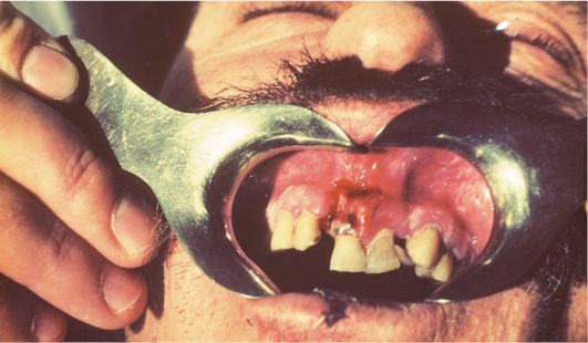 перелом нижней челюсти во время удаления зуба