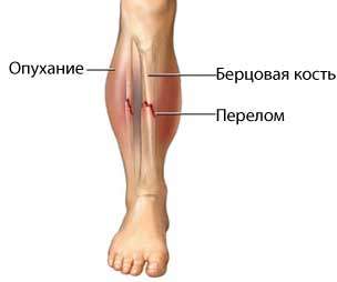 перелом нижней трети диафиза правой большеберцовой кости