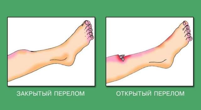 перелом ноги сколько ходить в гипсе взрослых