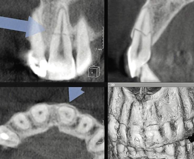 перелом в средней части корня зуба сопровождается
