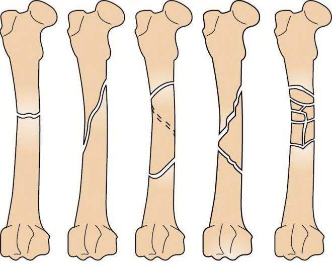 Перелом бедра рисунок