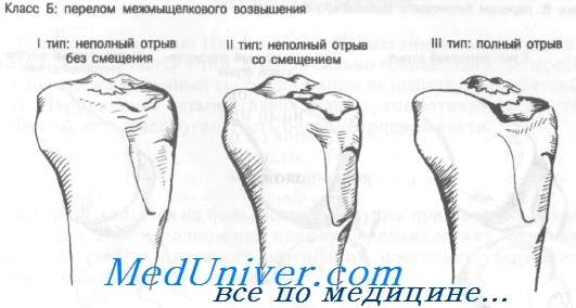 перелом заднего края дистального метаэпифиза большеберцовой кости