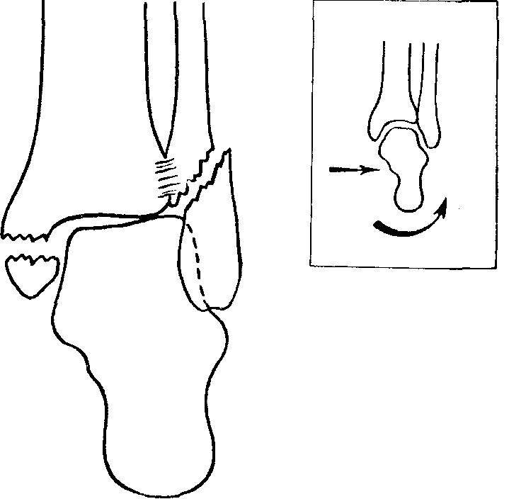 перелом заднего края дистального метаэпифиза большеберцовой кости