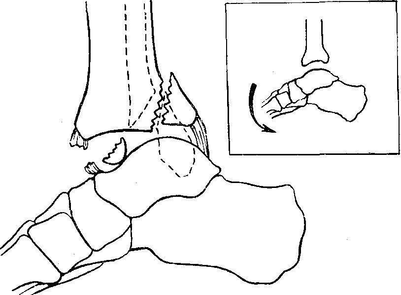 Задний край без смещения. Трехлодыжечный перелом схема. Перелом лодыжек и заднего края большеберцовой кости. Отломок заднего края большеберцовой кости. Перелом наружной лодыжки большеберцовой кости.