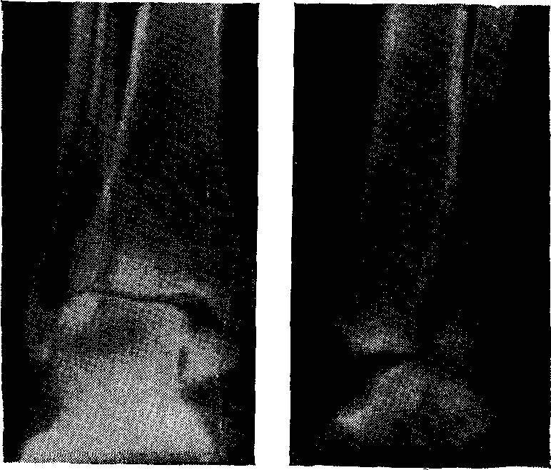 перелом заднего края дистального метаэпифиза большеберцовой кости