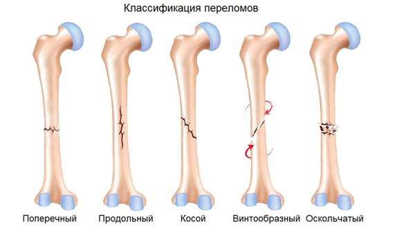 переломы проксимального отдела плечевой кости у детей