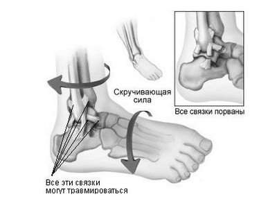 первая медицинская помощь при вывихе голеностопного сустава