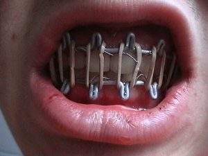 первая помощь при вывихе нижней челюсти при удалении зуба