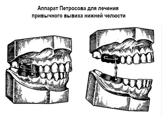 первая помощь при вывихе нижней челюсти во время удаления зуба
