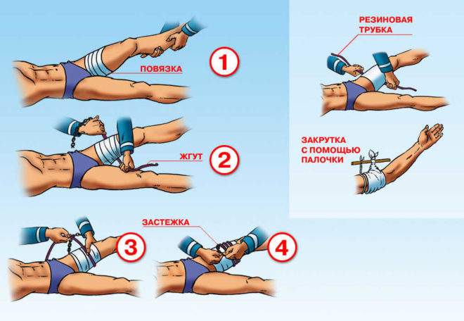 первая помощь при закрытом переломе бедра алгоритм