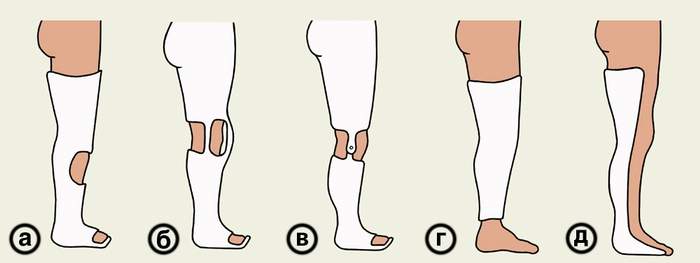 пластиковая лангета на ногу при переломе стопы