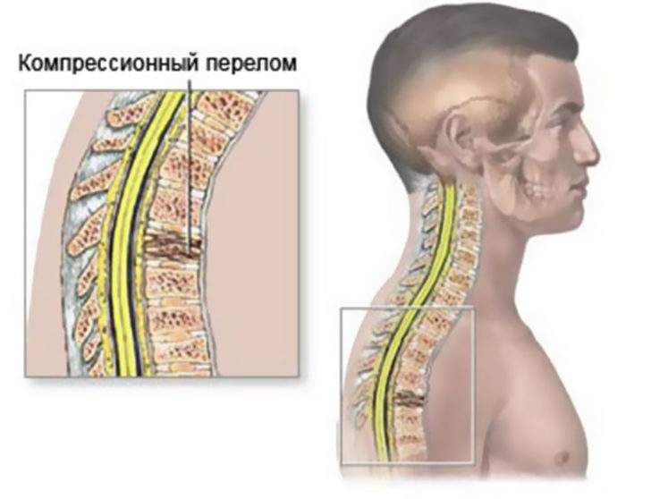 плавание при компрессионном переломе позвоночника у детей