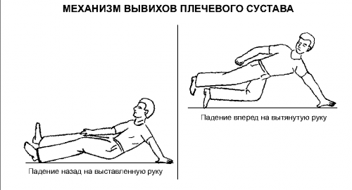 почему медики не рекомендуют самостоятельно вправлять кости в результате вывиха