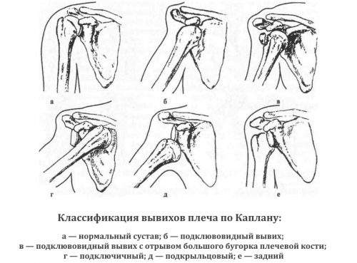 почему медики не рекомендуют самостоятельно вправлять кости в результате вывиха