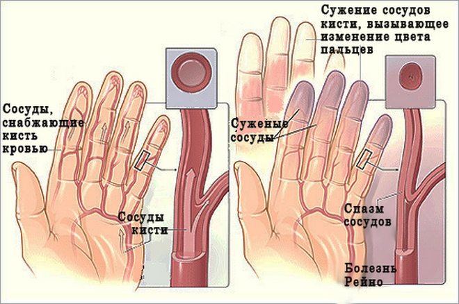 почему не сгибается палец на руке после ушиба