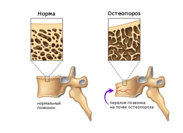 почему после перелома позвоночника не могут ходить